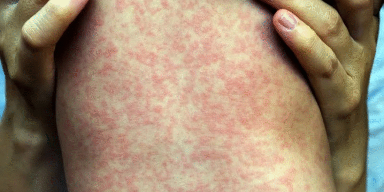 Primavera do Leste confirma terceiro caso de sarampo